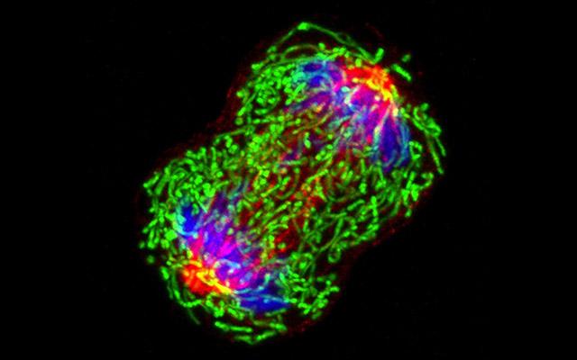 Vanderbilt Study Finds Diabetes May Hasten Breast Cancer Tumor Growth and Stiffness