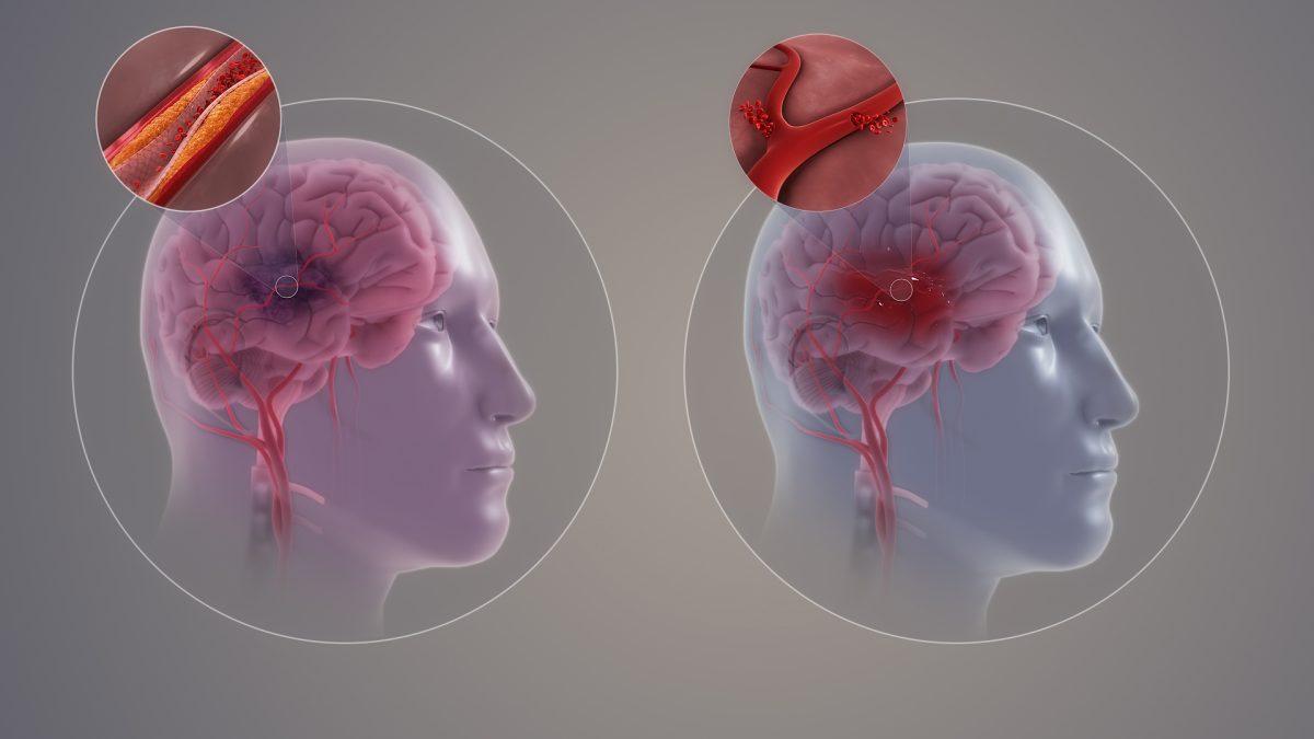 Neuralert: New Stroke Detection Device May Save Lives